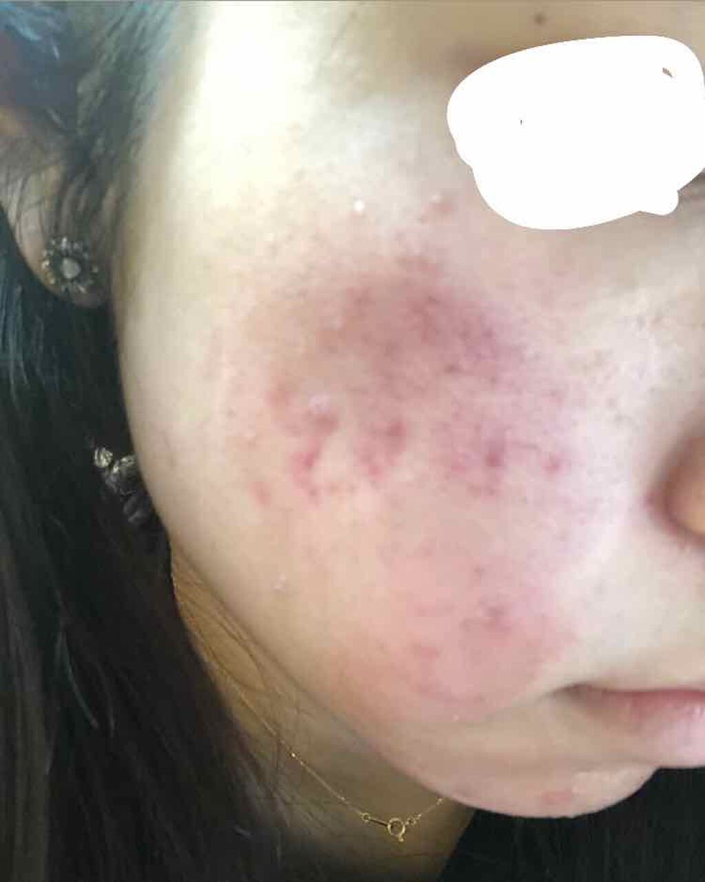 エピデュオゲル/マルホ株式会社/その他を使ったクチコミ（2枚目）