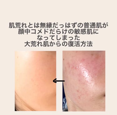 キュレル 皮脂トラブルケア 化粧水のクチコミ「普通肌がある日突然敏感肌になった話。

肌荒れ知らずだったはずが、花粉に蝕まれていき、ゆらぎ肌.....」（1枚目）