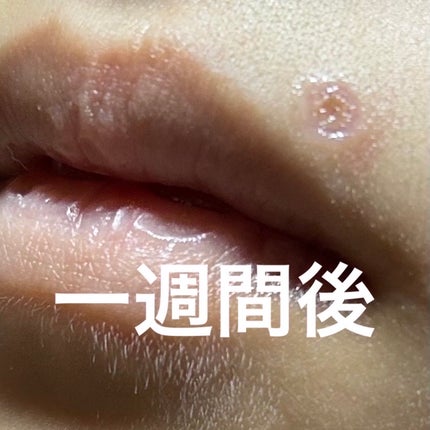 猫派 on LIPS 「ほくろ除去しました!!忘れないうちにメモします。私のほくろは膨..」(4枚目)