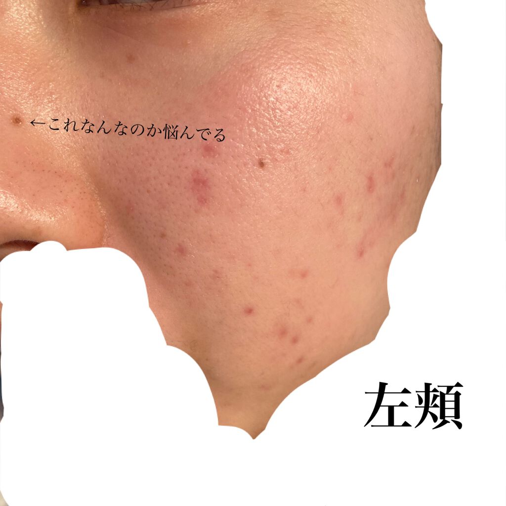 アクネケアローション W/d プログラム/化粧水を使ったクチコミ(2枚目)