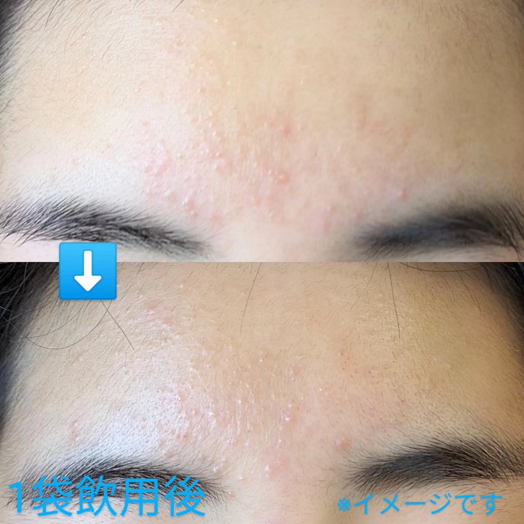 Hadaral 十味敗毒湯錠(医薬品)/大峰堂/その他を使ったクチコミ（1枚目）