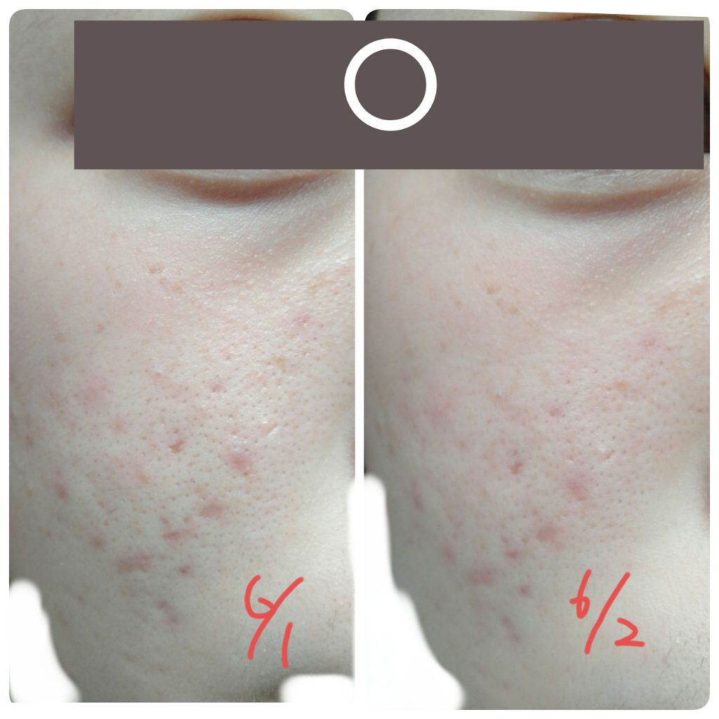 リアルカレンデュラピールオフパック/APRILSKIN/ピーリングを使ったクチコミ（2枚目）