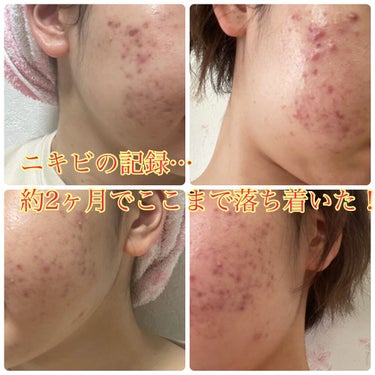 砂糖 on LIPS 「今回は皮膚科の薬について紹介していきます💭1つ前の投稿を見てい..」（1枚目）