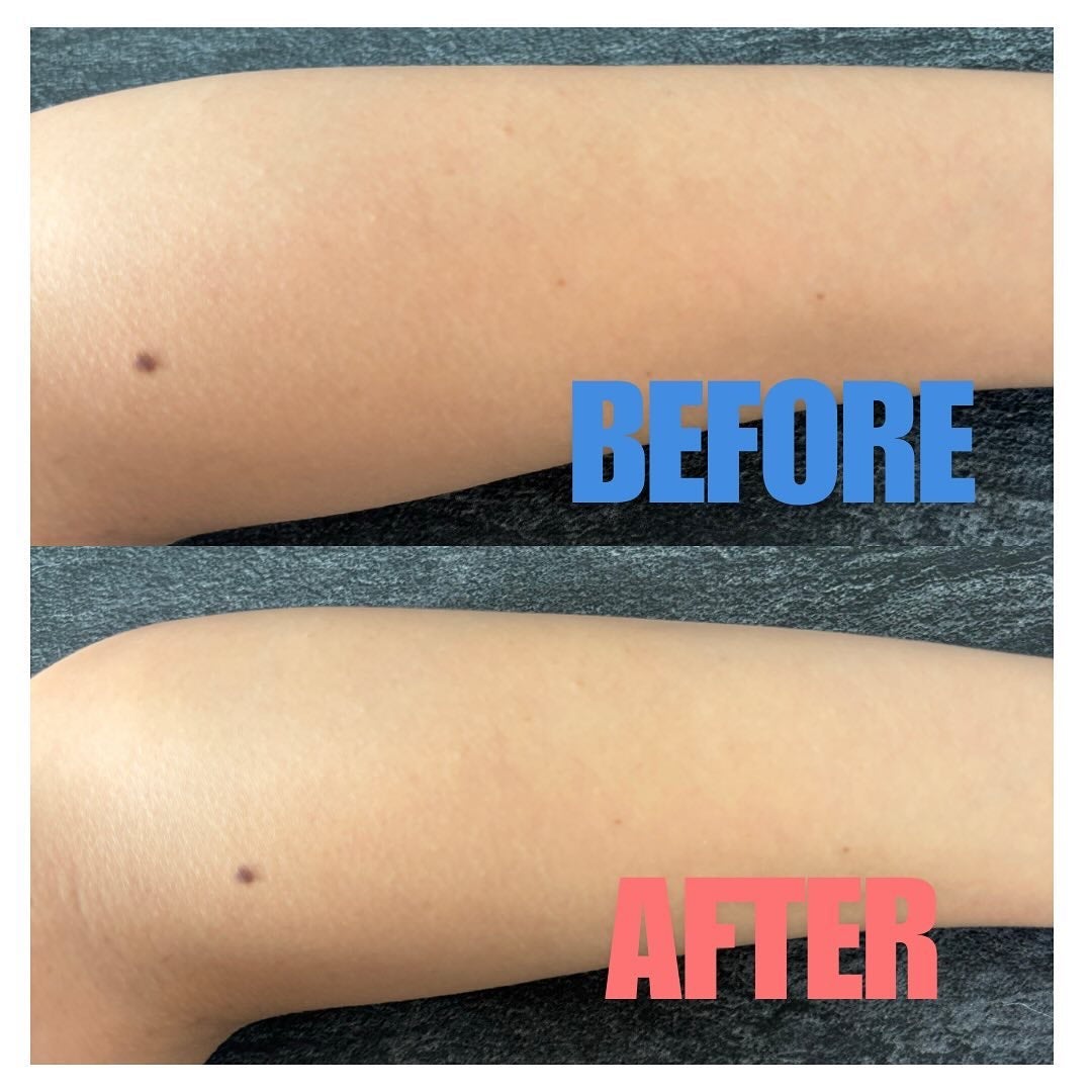 ティーツリーピュリファイングリーンアップサン/Dr.Ceuracle/日焼け止めミルクを使ったクチコミ(3枚目)