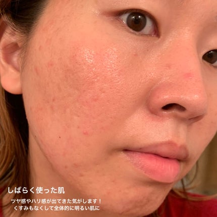 エンリッチ&コンセントレート VCエッセンス/N organic/美容液を使ったクチコミ(9枚目)