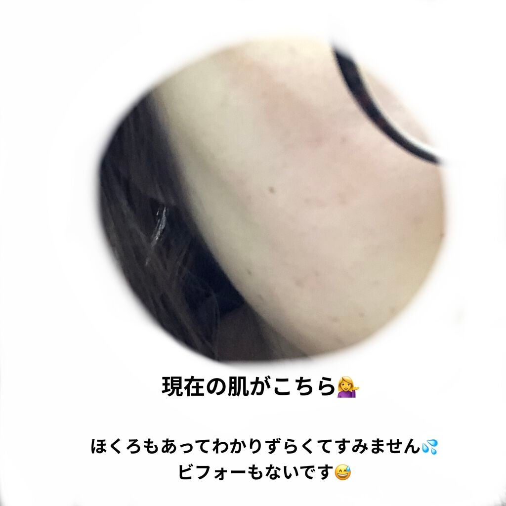 オロナインH軟膏 (医薬品)/オロナイン/その他を使ったクチコミ(2枚目)