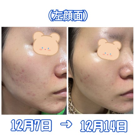 白潤 薬用美白化粧水(しっとりタイプ)/肌ラボ/化粧水を使ったクチコミ(3枚目)