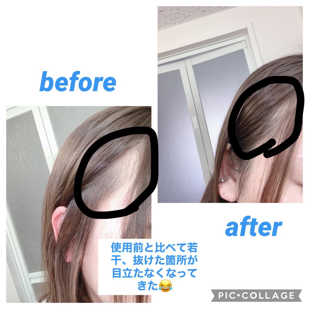 アングレワールドセレクション 薬用育毛剤+スカルプエッセンス/アングレ/その他を使ったクチコミ（2枚目）