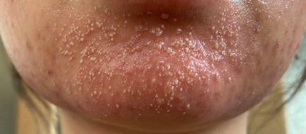 マデカソ CICAクリーム /A’pieu/フェイスクリームを使ったクチコミ(2枚目)