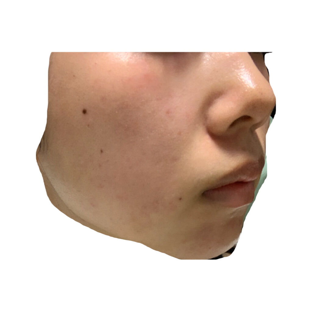 ベピオゲル/マルホ株式会社/その他を使ったクチコミ（1枚目）