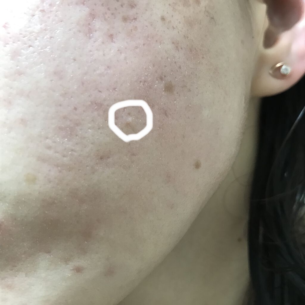 レチノールA 1% アドバンスドリバイタリゼーションクリーム/Life-flo/フェイスクリームを使ったクチコミ（1枚目）