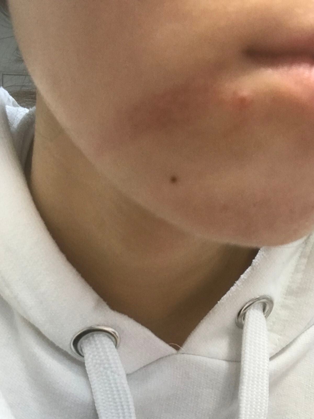 ちあき on LIPS 「皆さん、こんばんわ✨今日は助けて欲しくて😭私の肌の話です(><..」(2枚目)