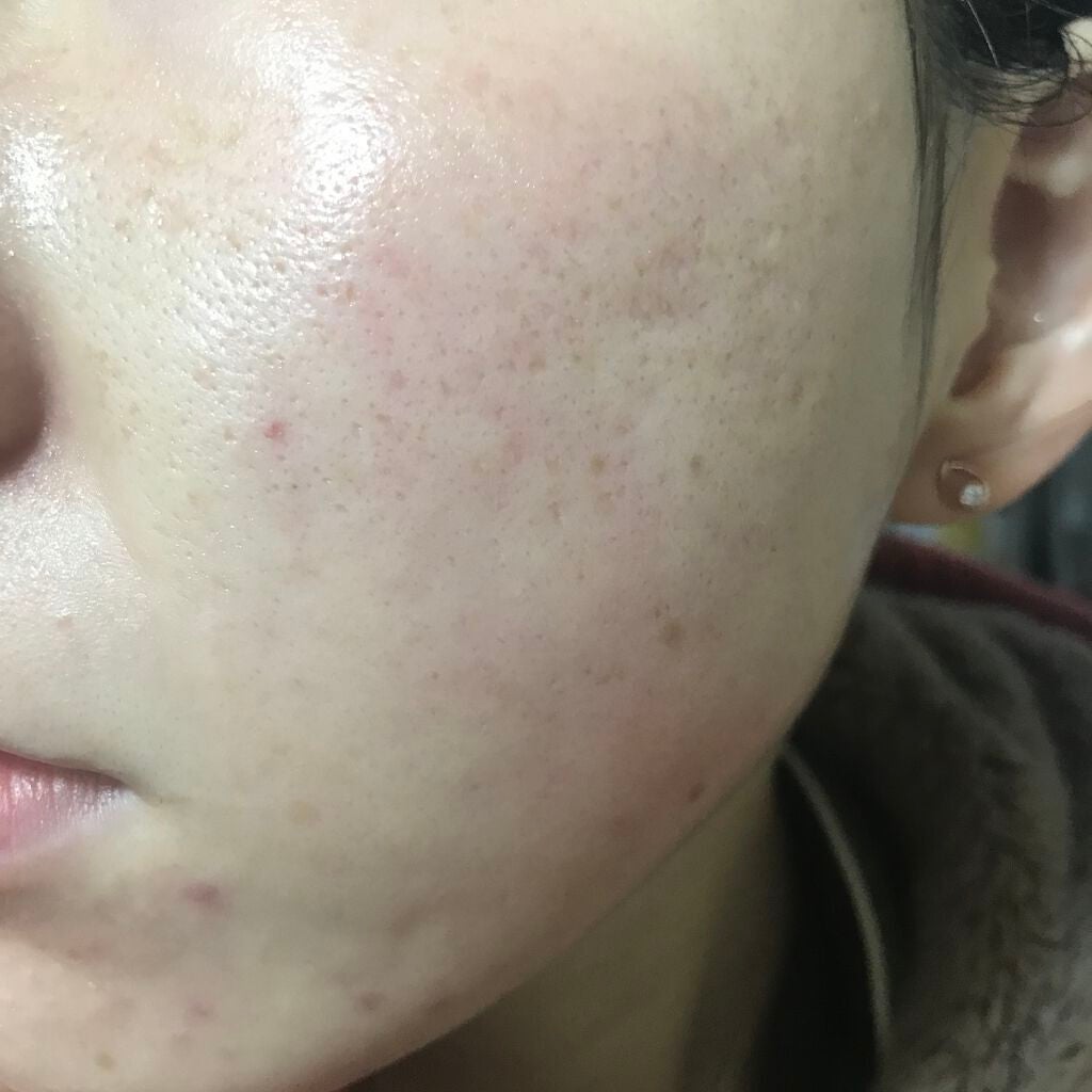 ティーツリーケア ソリューション エッセンシャルマスクEX/MEDIHEAL/シートマスク・パックを使ったクチコミ(2枚目)