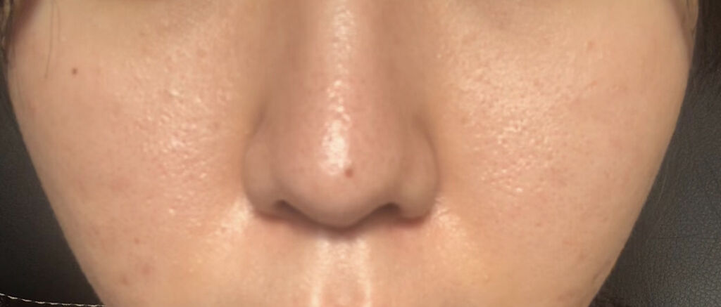 ペアアクネクリームW(医薬品)/ペア/その他を使ったクチコミ（2枚目）