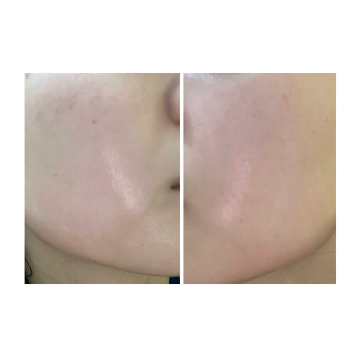 ぽむ on LIPS 「2023.9.13皮膚科に受診 エピデュオとヘパリン処方1枚目..」(4枚目)