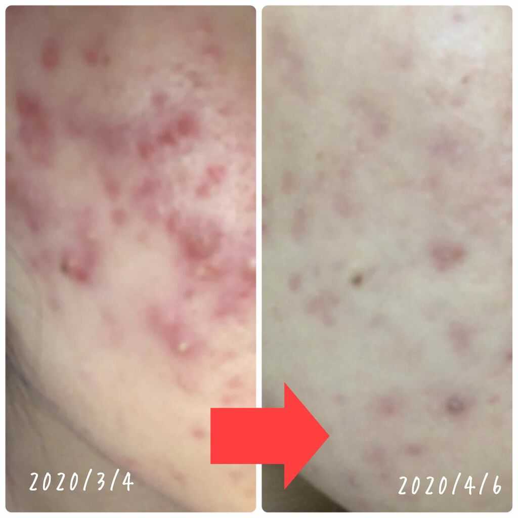 オードムーゲ 薬用ローション(ふきとり化粧水)/オードムーゲ/拭き取り化粧水を使ったクチコミ(2枚目)