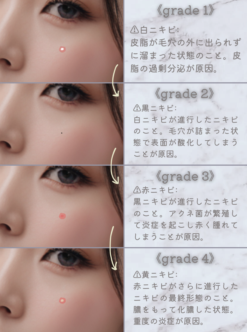 オードムーゲ 薬用ローション(ふきとり化粧水)/オードムーゲ/拭き取り化粧水を使ったクチコミ(2枚目)