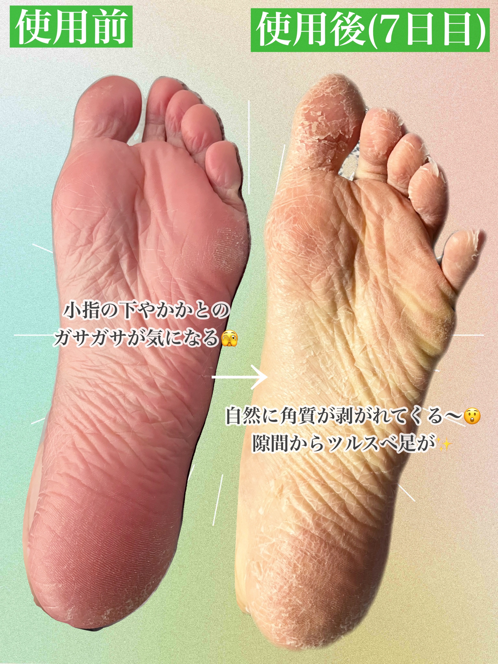 イージーパックDP60分タイプ/ベビーフット/レッグ・フットケアを使ったクチコミ（3枚目）