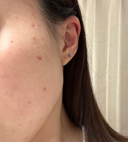 ニキビあとケアジェル/アットノン/その他スキンケアを使ったクチコミ(2枚目)