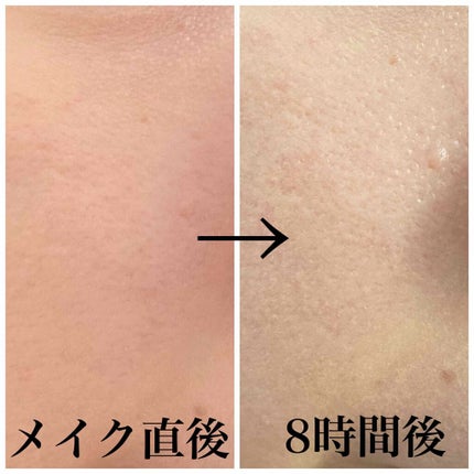 光美容器KE-NON(ケノン)/エムテック/家庭用脱毛器を使ったクチコミ(4枚目)