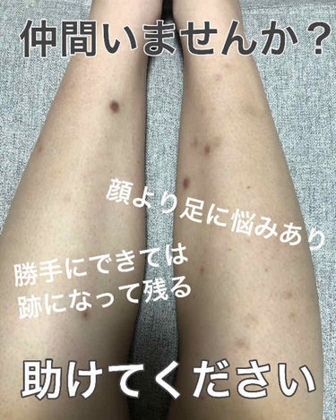 アドバイス、共感、なんでもありませんか！？
（見苦しい物みせてすみません）


いつのまにかニキビみたいなのができたり、クレーターみたいに陥没したちょっとぐちゅっとした感じのができたりします

3枚目の