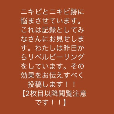 薬用3ステップセット30日サイズ/プロアクティブ/トライアルキットを使ったクチコミ（1枚目）