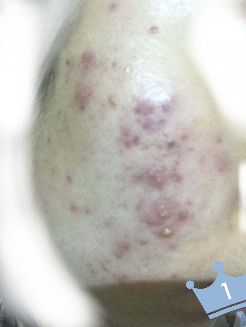 にきび治療薬C(医薬品)/ピンプリット/その他を使ったクチコミ（3枚目）