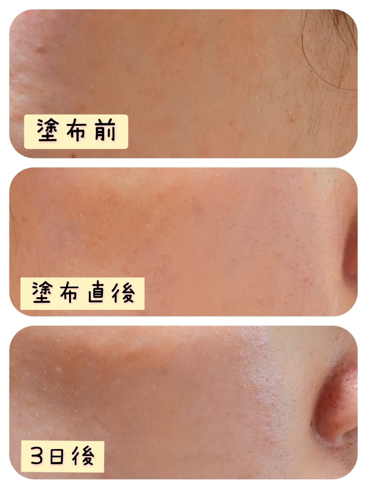 マイルドリードルショット50/VT/美容液を使ったクチコミ（3枚目）