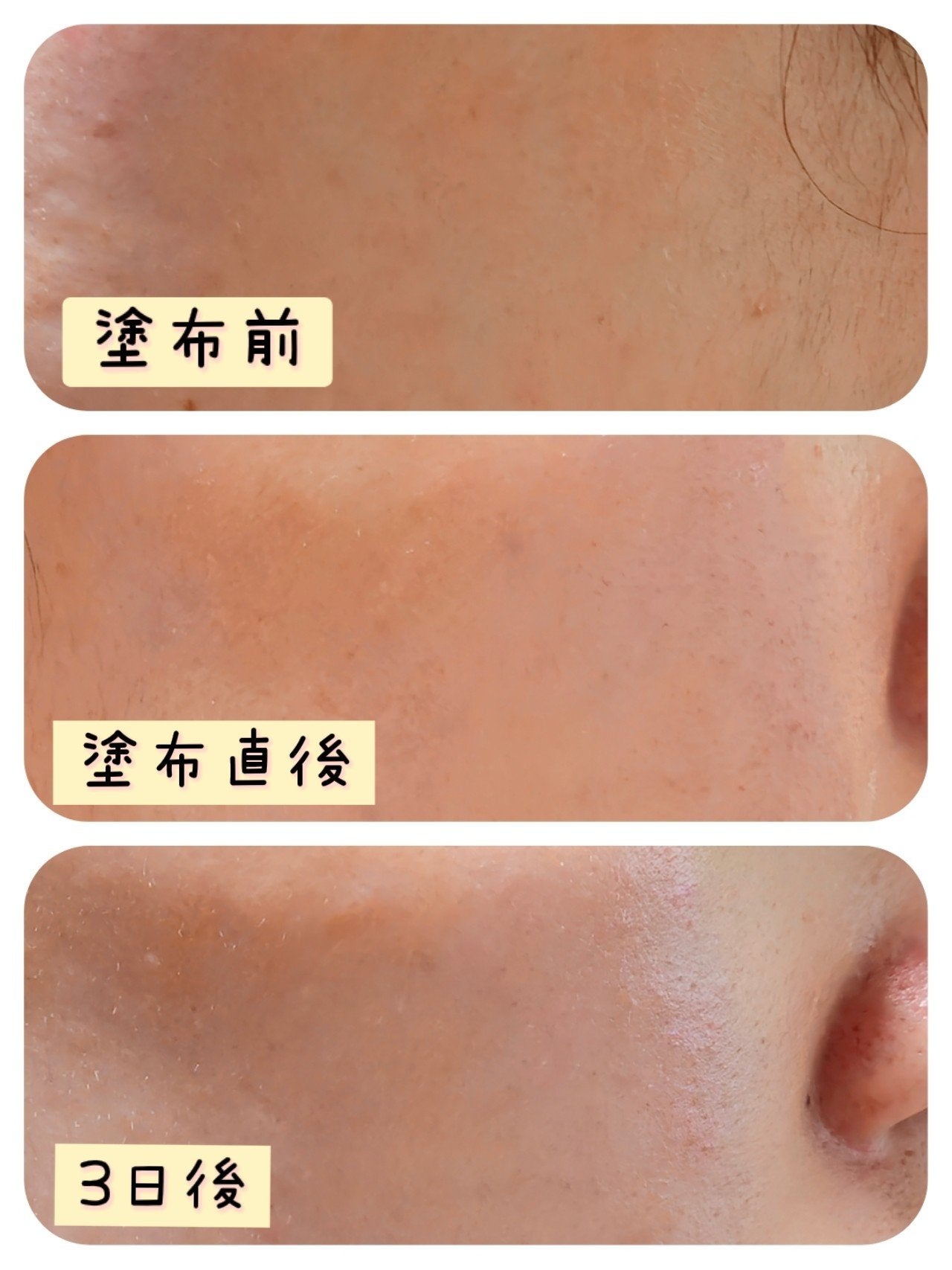 マイルドリードルショット50/VT/美容液を使ったクチコミ(3枚目)