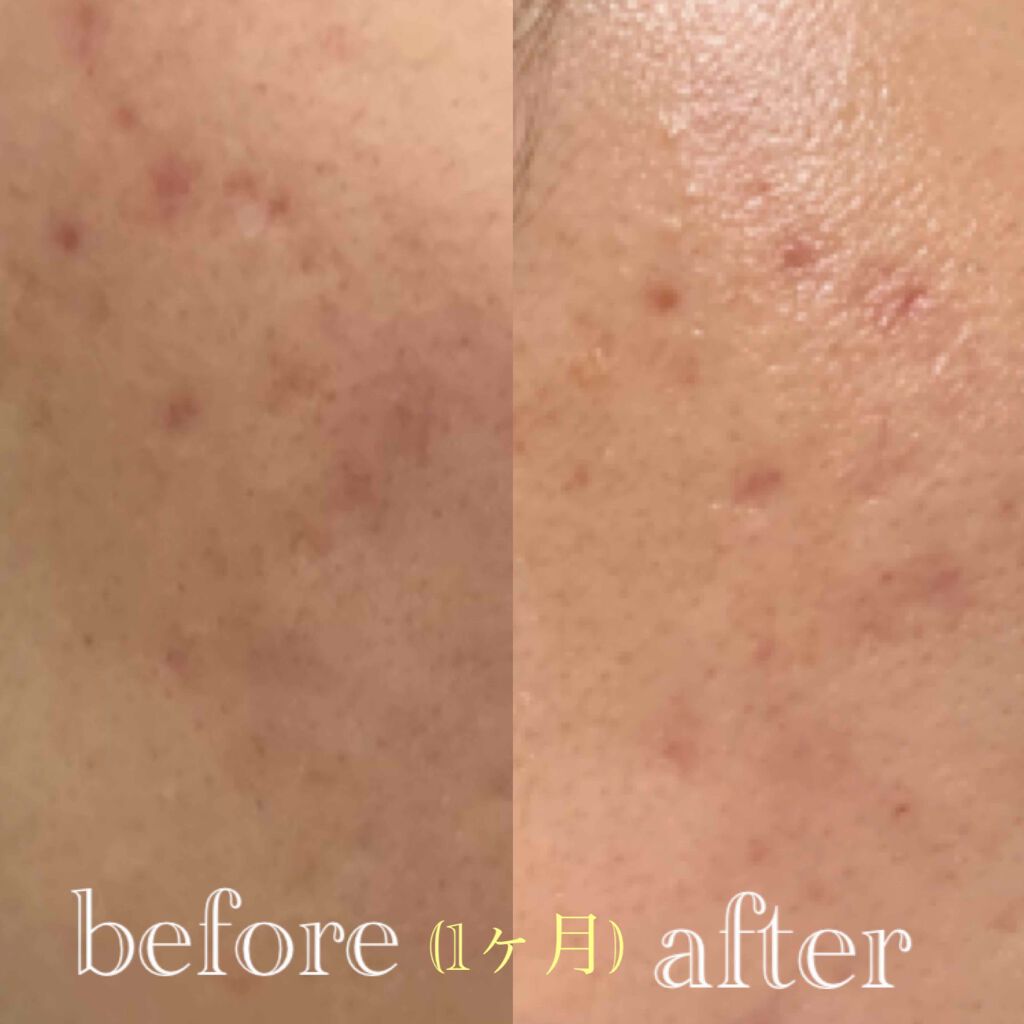 Glycolic Acid 7% Toning  Solution/The Ordinary/ブースター・導入液を使ったクチコミ（2枚目）