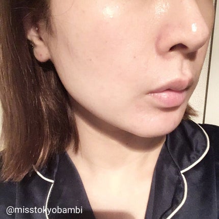 ヒアルロン酸注入/プラウドクリニック/その他を使ったクチコミ(5枚目)