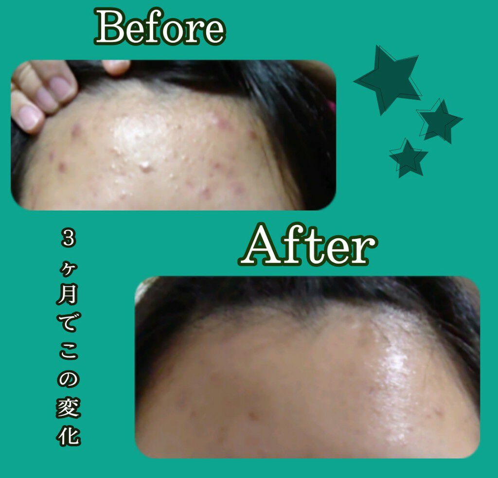 薬用ニキビケア ウォッシングフォーム（思春期用）/アクネスラボ/洗顔フォームを使ったクチコミ（3枚目）