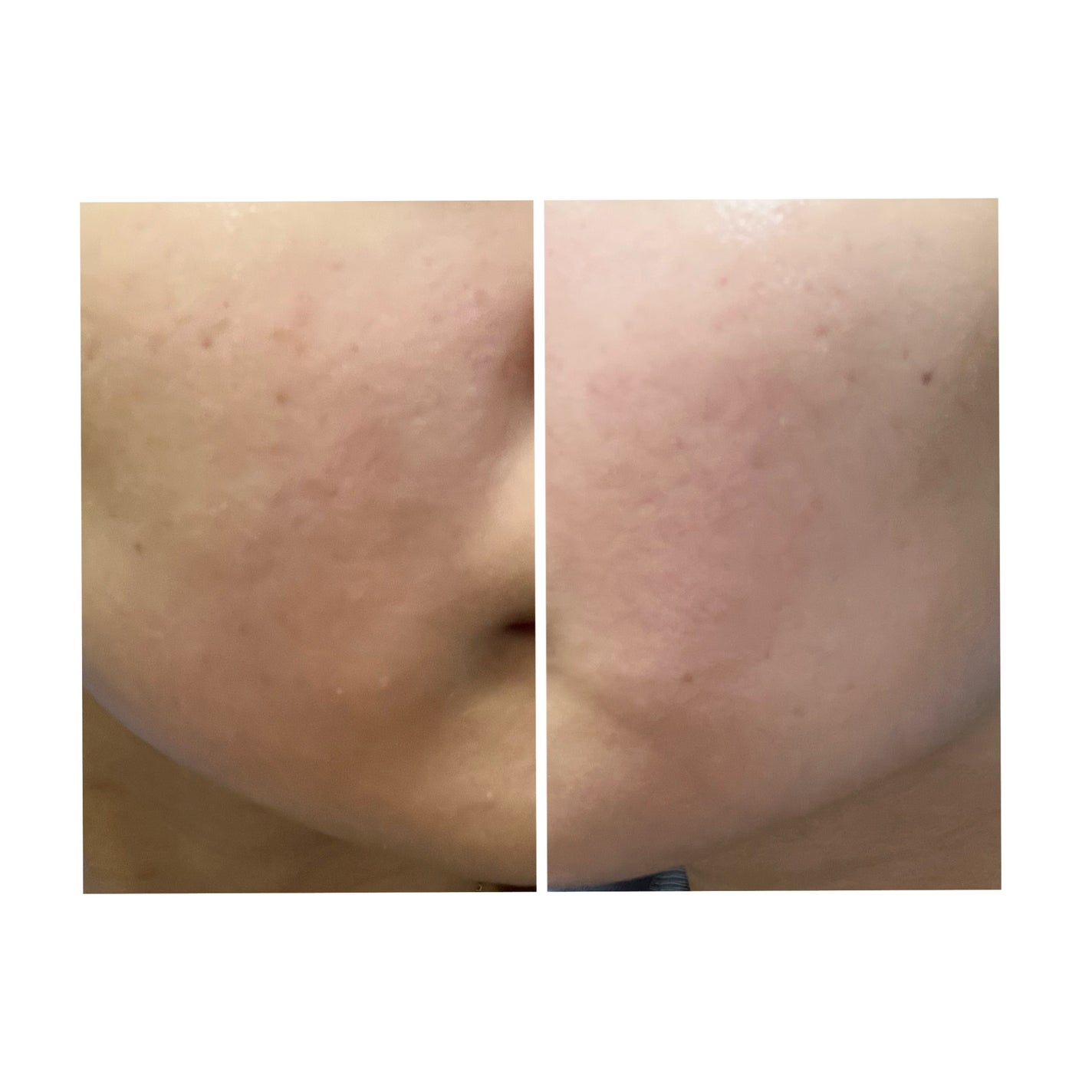 ぽむ on LIPS 「2023.9.13皮膚科に受診 エピデュオとヘパリン処方1枚目..」(4枚目)