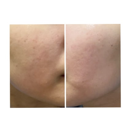 ぽむ on LIPS 「2023.9.13皮膚科に受診 エピデュオとヘパリン処方1枚目..」(4枚目)