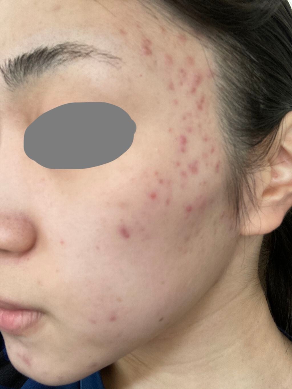 fantastic_make_9nly on LIPS 「ニキビ治療記録..」(2枚目)