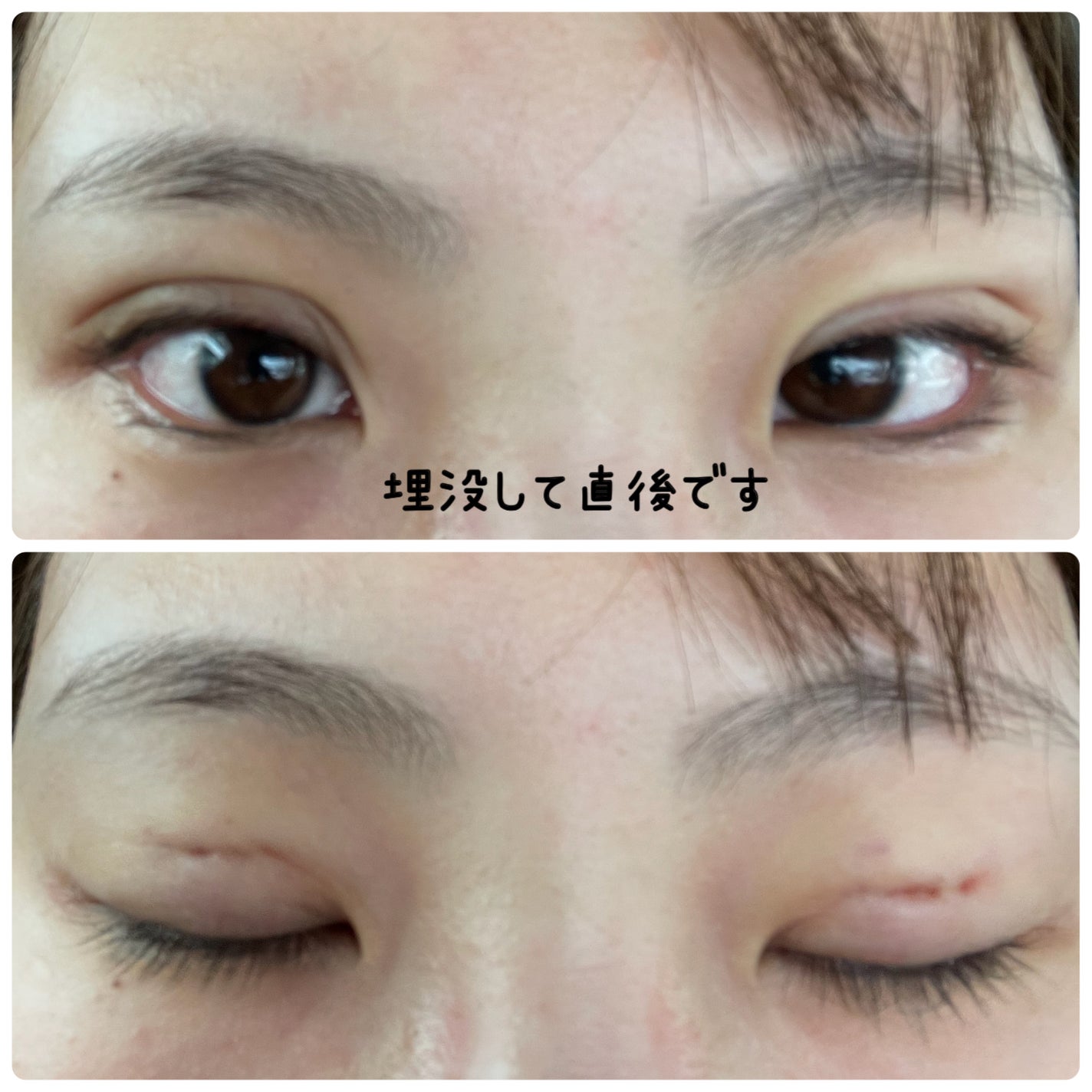 ナイトアイボーテ/StreeTrend/二重まぶた用アイテムを使ったクチコミ(4枚目)