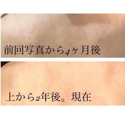 ニキビを防ぐ薬用石鹸 ForBack/ペリカン石鹸/ボディ石鹸を使ったクチコミ(2枚目)