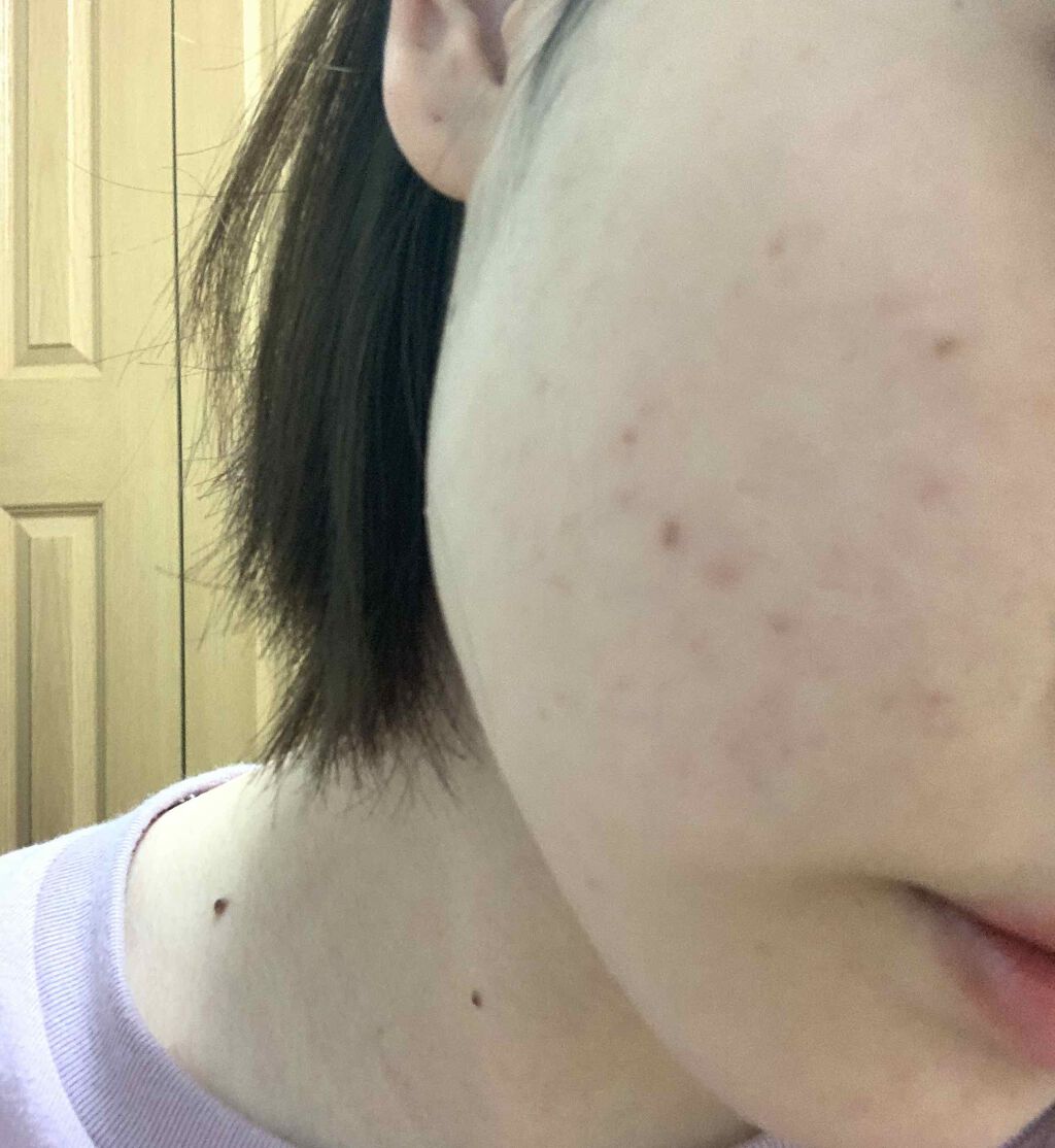 ゆりじみ on LIPS 「先週肌荒れが気になって皮膚科に行ってみましたがデュアック配合ゲ..」(2枚目)