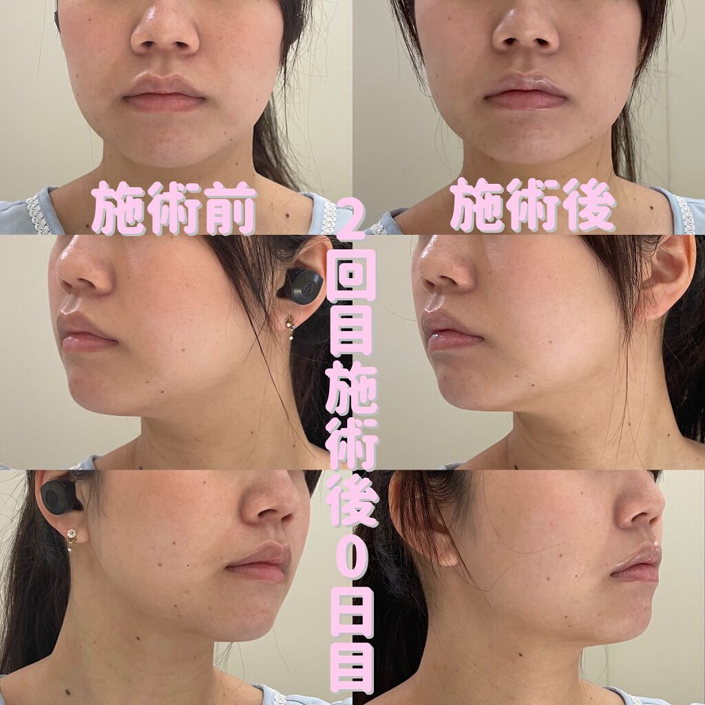 輪郭スッキリQ+/湘南美容/その他を使ったクチコミ（3枚目）
