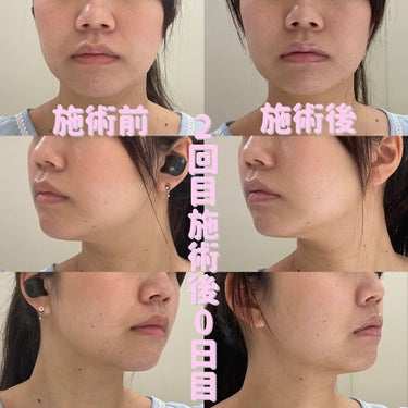 Tomomi on LIPS 「はじめての美容医療〜脂肪溶解リニアHIFU〜2回目施術後0日目..」（3枚目）