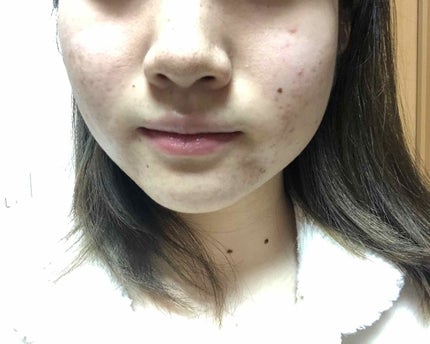 マンスリースキンケアプログラム(旧)/APEX/スキンケアキットを使ったクチコミ(2枚目)