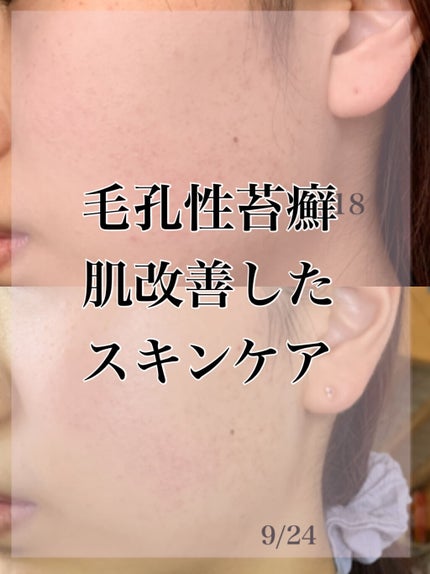 カプセルレシピパック N B&A/innisfree/洗い流すパック・マスクを使ったクチコミ(1枚目)