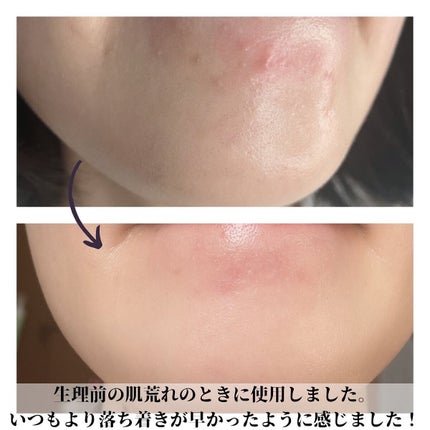 アクニドクターファーストスピーディースポット/ISOI/美容液を使ったクチコミ(4枚目)