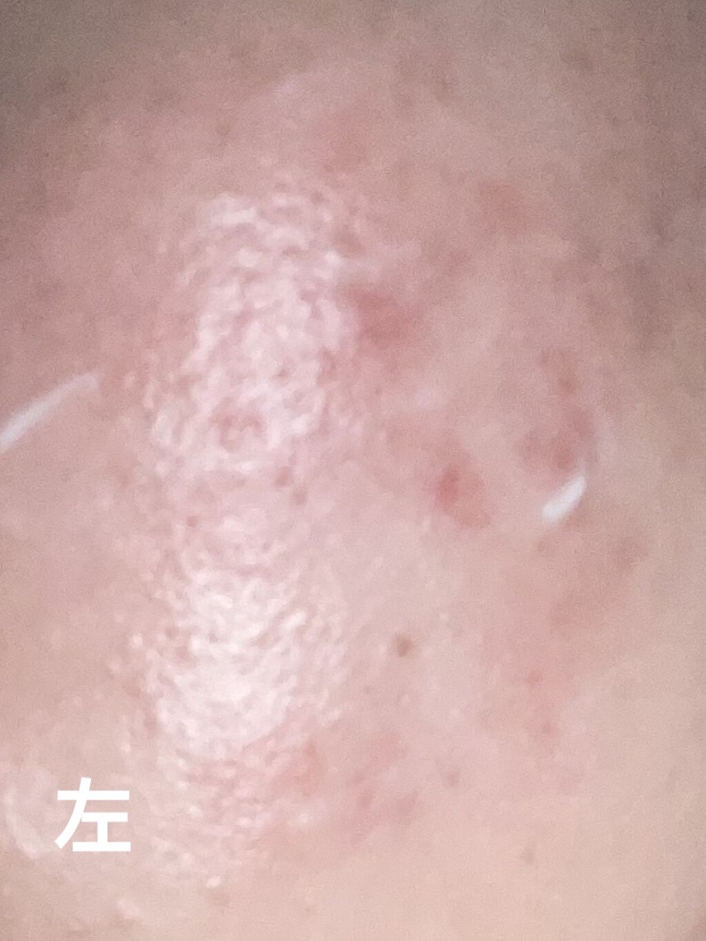 ディフェリンゲル0.1%/ガルデルマ/その他スキンケアを使ったクチコミ（1枚目）