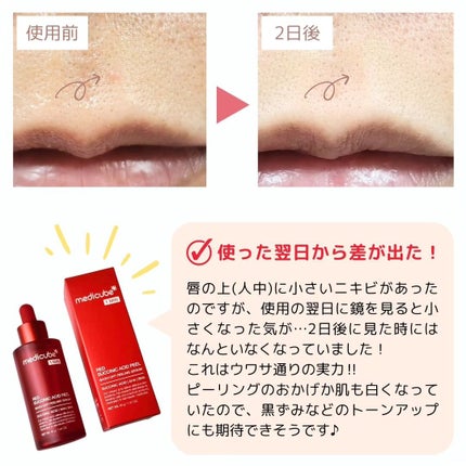 レッドアクネピーリングセラム/MEDICUBE/美容液を使ったクチコミ(4枚目)