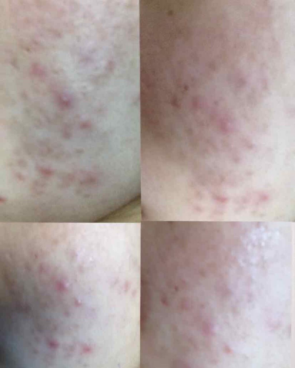 supreme_lips_8sa on LIPS 「私の肌荒れ記録(閲覧注意⚠️)こんにちは。私は小学生の頃からニ..」(2枚目)