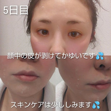 ゆなcc:フォロバ100 on LIPS 「BQCELLダーマスキンケアピーリング🎊1week体験投稿🎊1..」(6枚目)