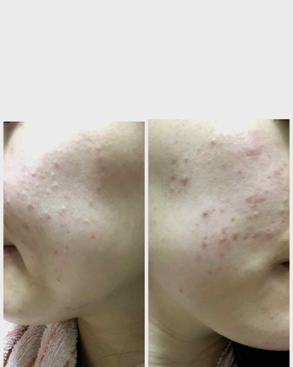 アクネキュアクリーム(医薬品)/IHADA/その他を使ったクチコミ(3枚目)