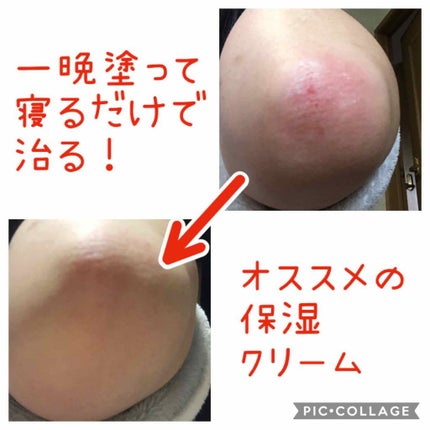 コーワ20%尿素配合クリーム(医薬品)/ケラチナミン/その他を使ったクチコミ(1枚目)