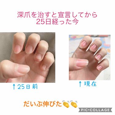 クイックケアコート Ettusaisを使った口コミ 深爪を治すと宣言してから25日経った今だい By ふう 混合肌 代前半 Lips